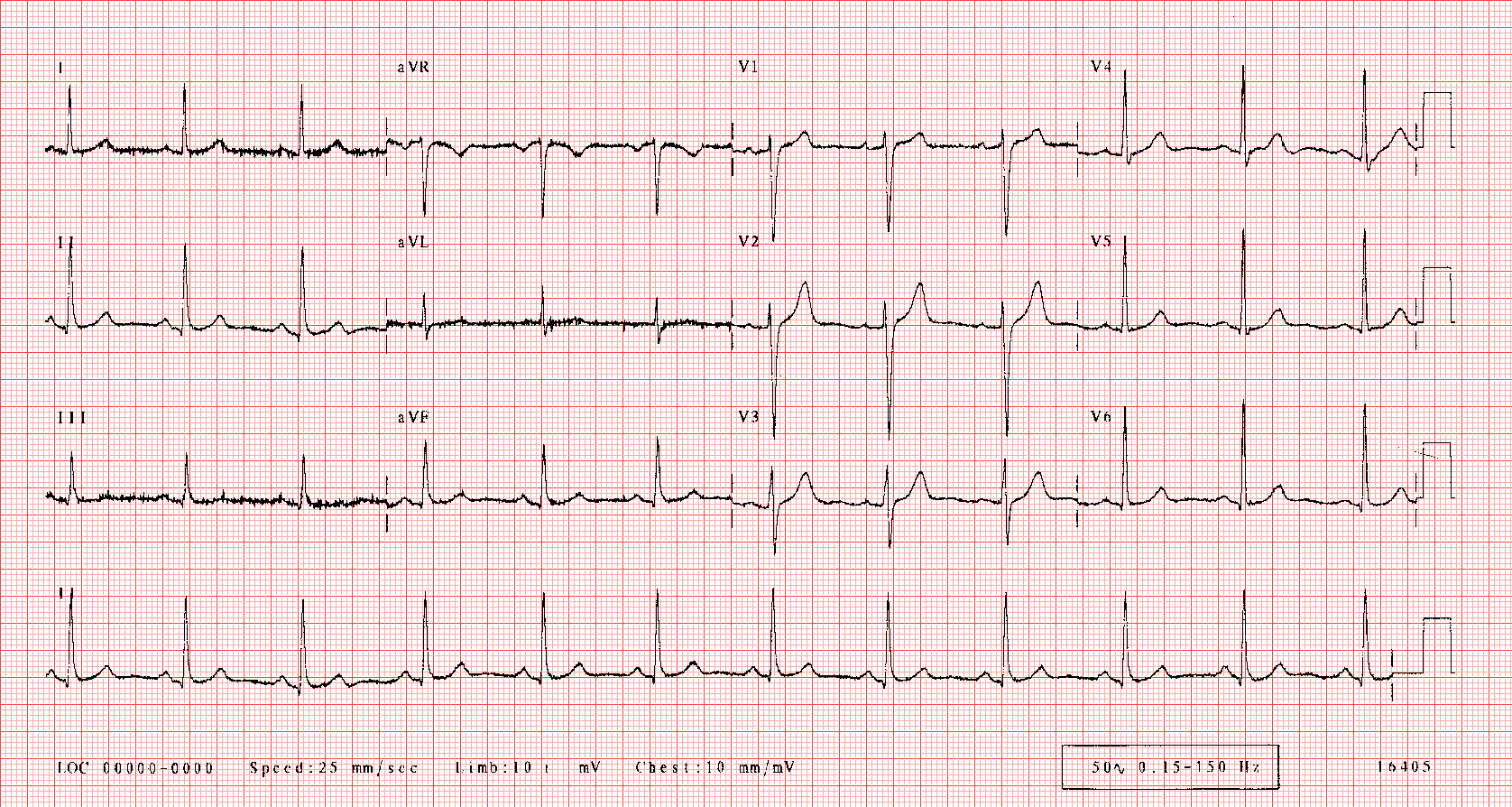 Sample ECG Report